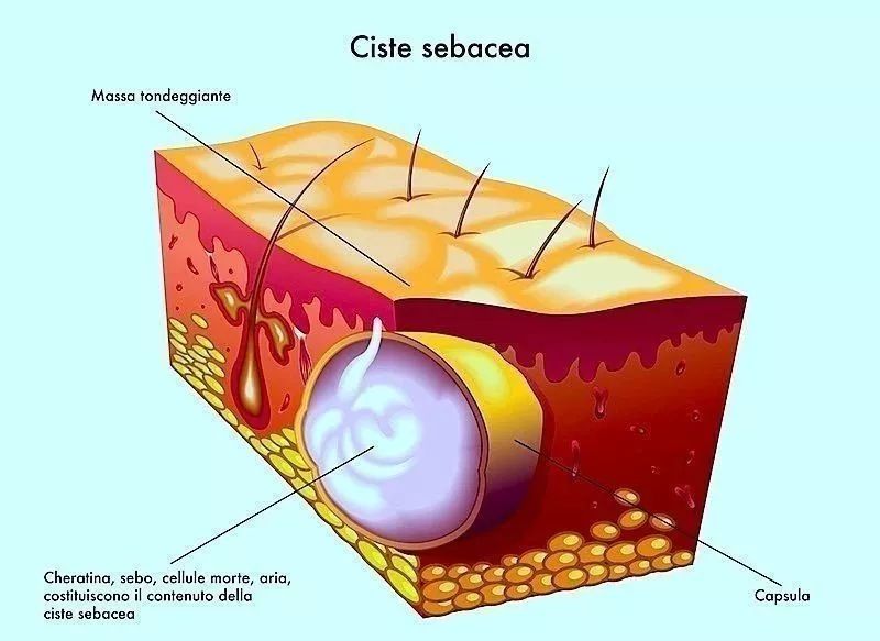 《科学》子刊：降糖又祛痘是什么道理？科学家意外发现一款糖尿病药物可以控制皮肤出油，有助于治疗*疮痤**|科学大发现