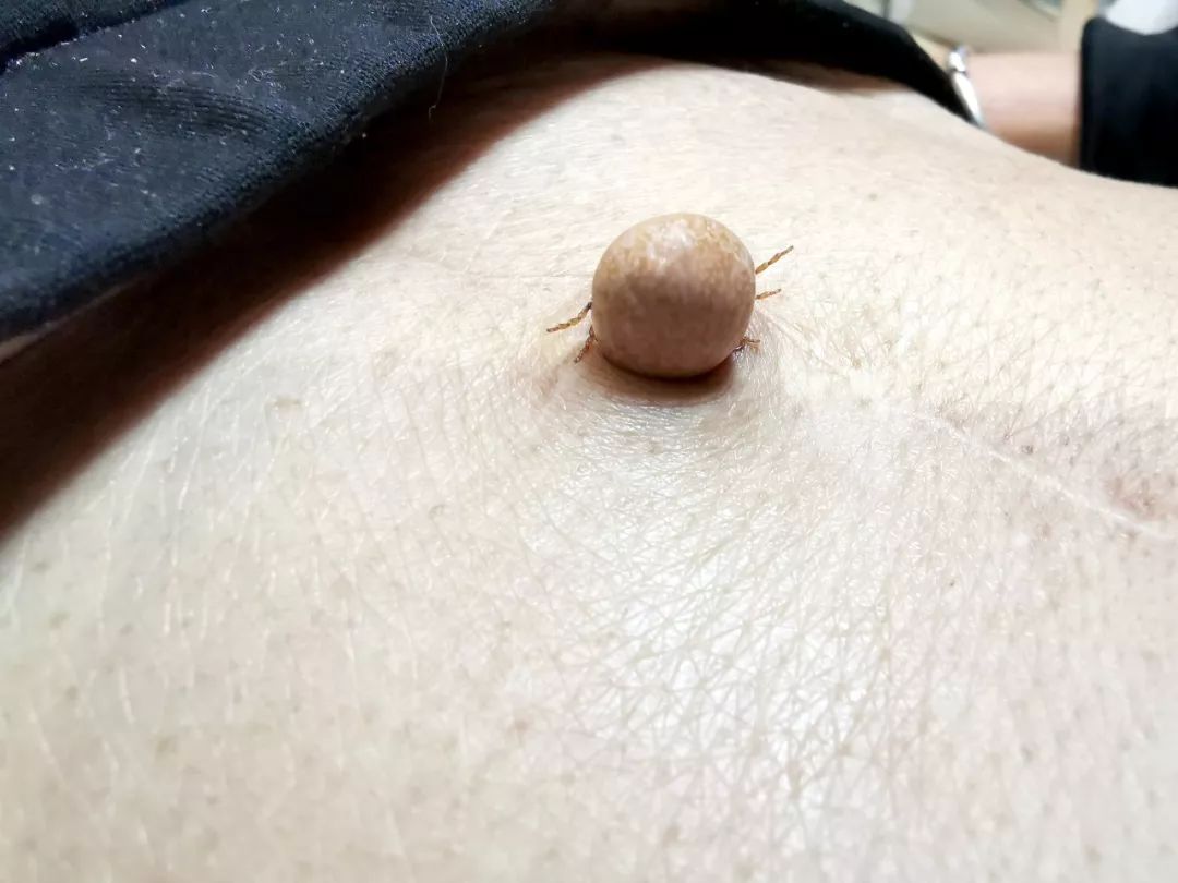 成人肚脐眼凸起肉球,肚脐眼隆起的肉球