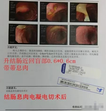 肠息肉内镜切除后迟发性出血，该怎么办？