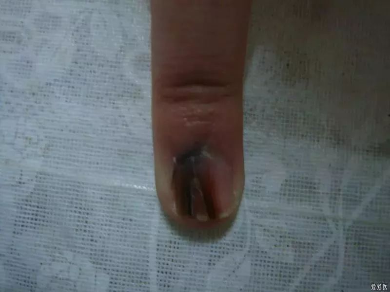 女子指甲上多出一条线没当回事，现在为保命竟要截掉