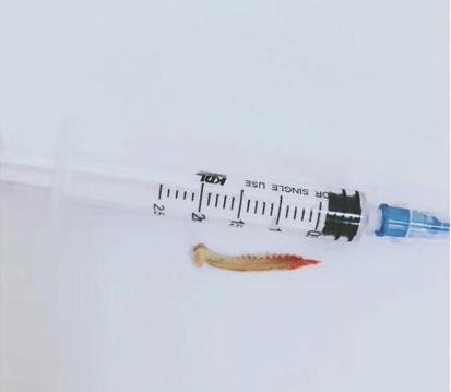 江苏鱼刺卡喉,慈溪鱼刺卡到喉咙1分钟轻松解决