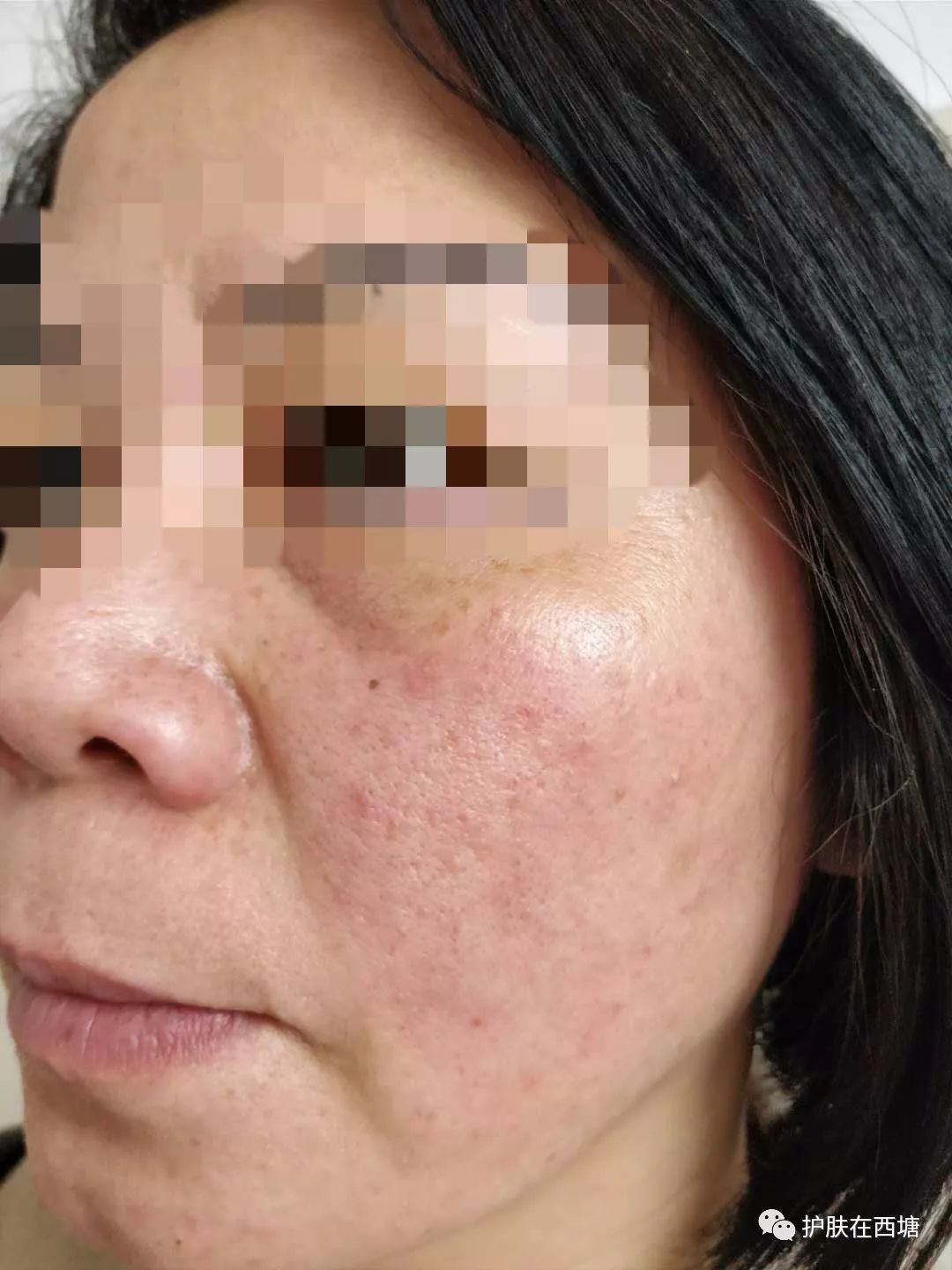 关于皮肤皮炎的几种症状,面部激素依赖性皮炎能好吗