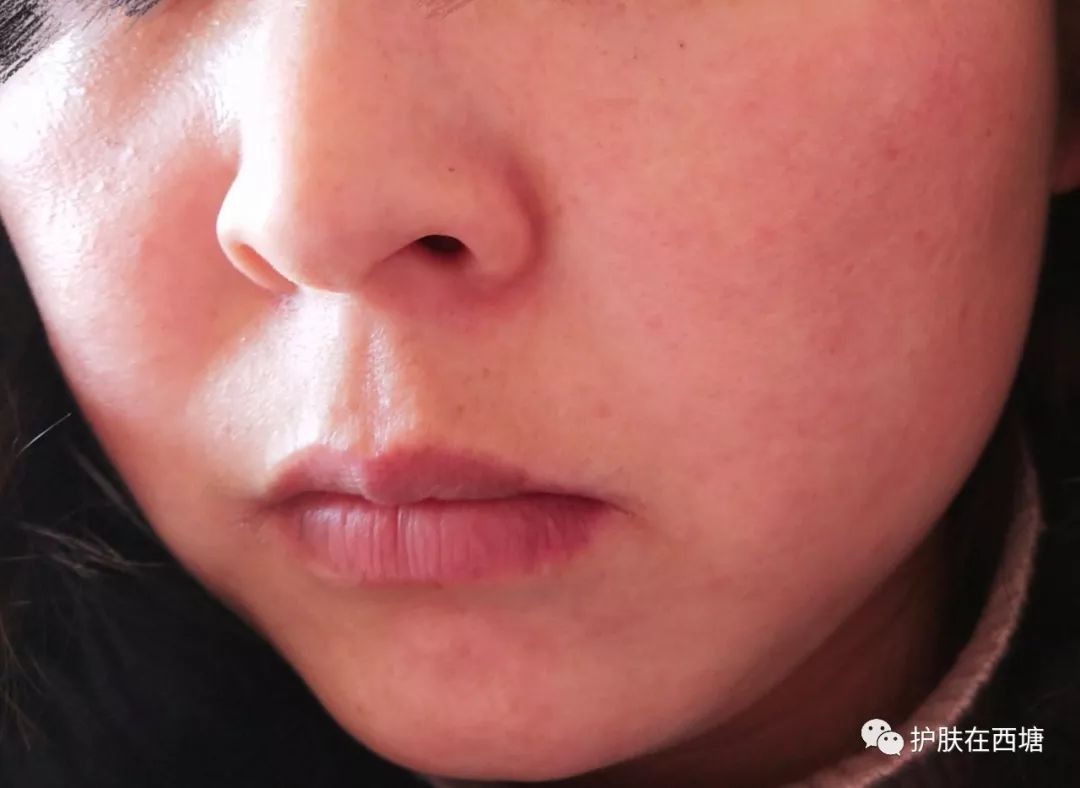 关于皮肤皮炎的几种症状,面部激素依赖性皮炎能好吗