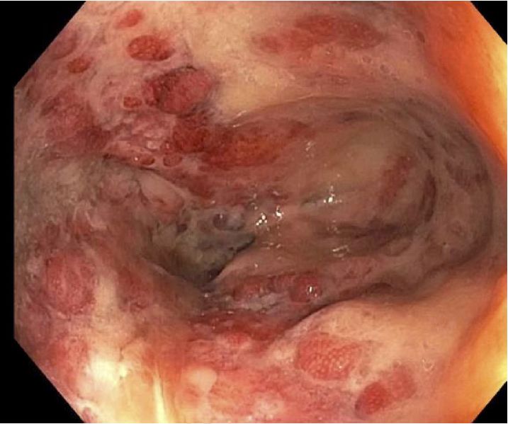 病例分享|一键保存！年轻女性因直肠疼痛而无法坐下？