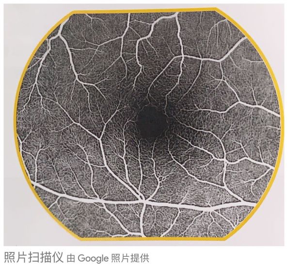 眼底黄斑病变一般多久会失明,眼底黄斑病的养护和关注事项