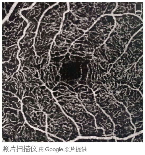 眼底黄斑病变一般多久会失明,眼底黄斑病的养护和关注事项