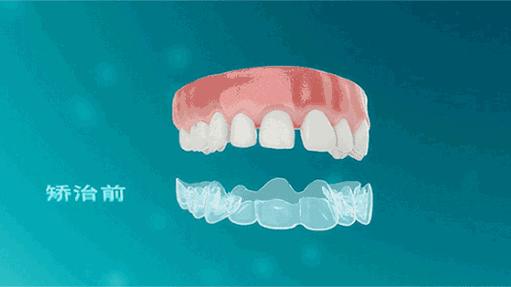 别人矫牙1万起，广州只要3960元！仅限2天
