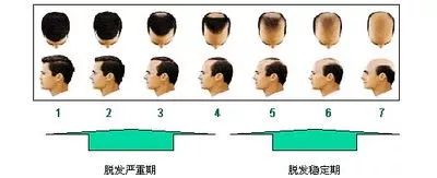 地中海头发改善视频,头发浓密但是有斑秃