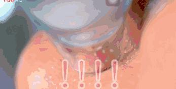 草莓鼻救星怎么治疗,草莓鼻去黑头神器视频