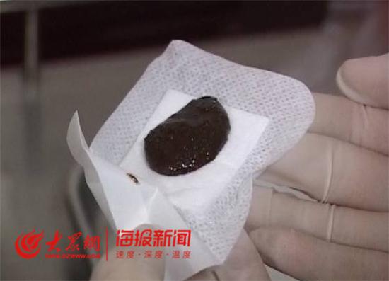 淄博市中心医院肿瘤科治疗头颈癌,淄博中西医结合医院中药怎么样