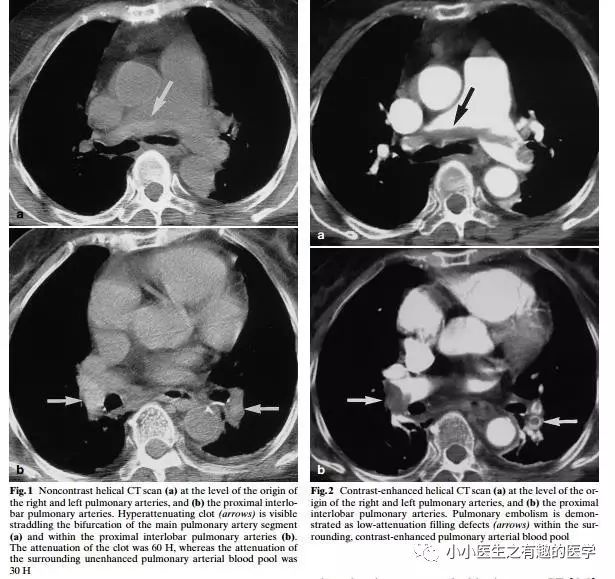 ct平扫肺部能查出是哮喘吗,ct平扫肺结节准确吗