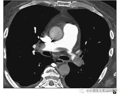 ct平扫肺部能查出是哮喘吗,ct平扫肺结节准确吗
