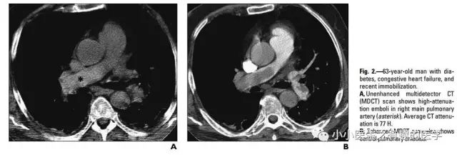 ct平扫肺部能查出是哮喘吗,ct平扫肺结节准确吗