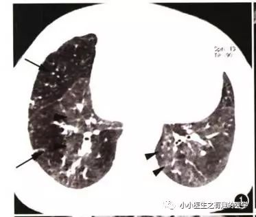 ct平扫肺部能查出是哮喘吗,ct平扫肺结节准确吗