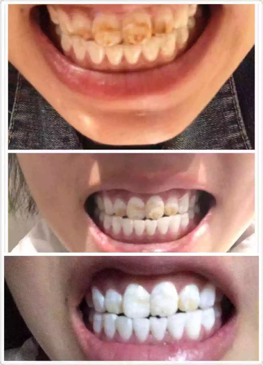 牙黄口臭的克星，有效洁白牙齿，并让口气清新！烟民必备的牙膏