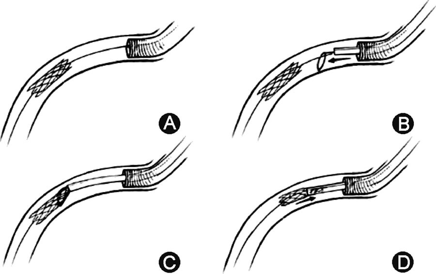 冠脉支架抗凝治疗专家共识,冠状动脉破裂的处理方法