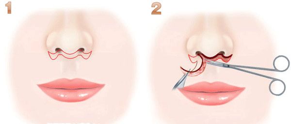 人中缩短还可以变回去吗,人中缩短值得做吗