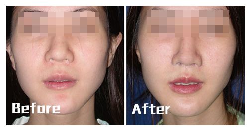 人中缩短还可以变回去吗,人中缩短值得做吗