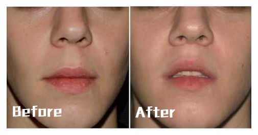 人中缩短还可以变回去吗,人中缩短值得做吗