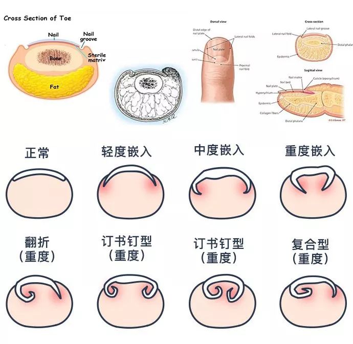 外科医生甲沟炎,甲沟炎医生推荐