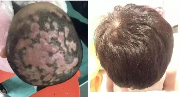 4岁女孩头发几乎掉光，头皮流脓！原因竟和家里这个有关