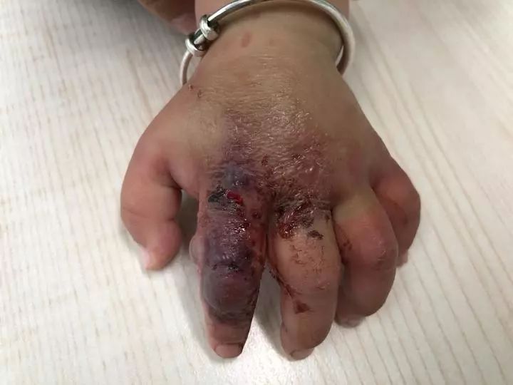 10个月了宝宝左手肿,1岁宝宝手肿得像馒头