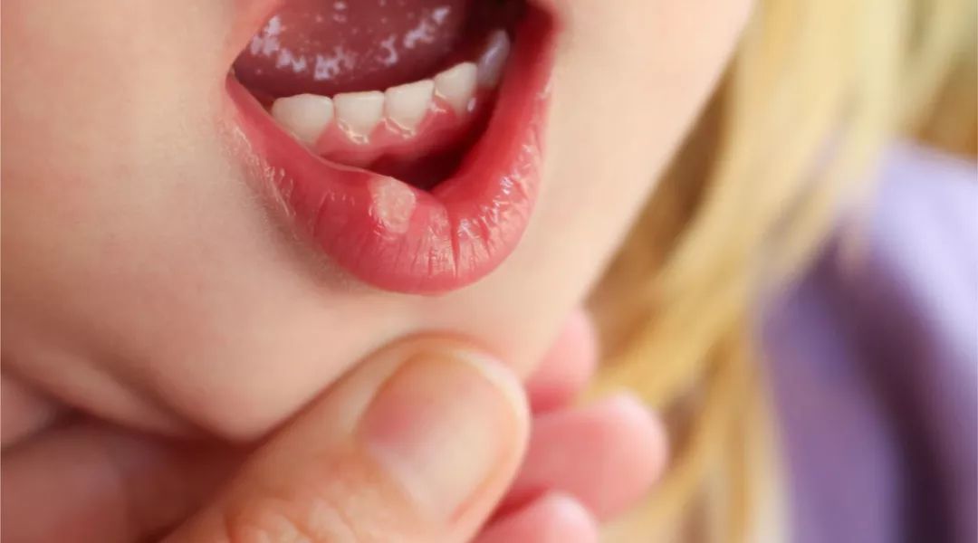 成年人做过最勇敢的事，就是咬破口腔溃疡