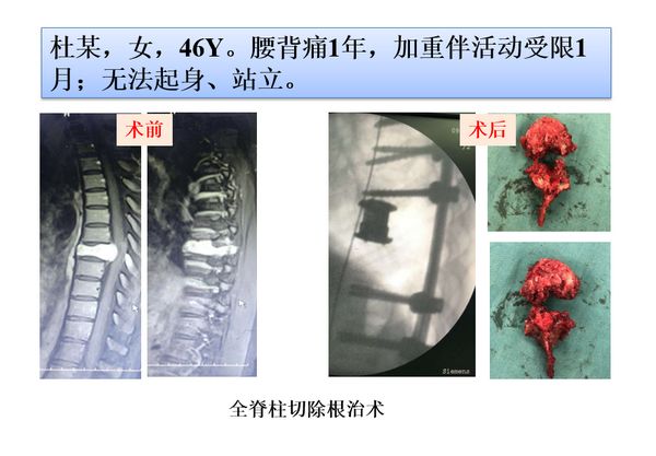 「筋骨堂」脊柱肿瘤可精准诊断，治疗选择大小皆宜