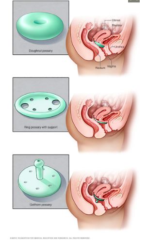尿失禁治疗护理及预防知识,尿失禁自愈的最佳方法土法