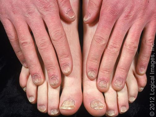 指甲很脆是因为缺少什么营养素,婴儿指甲特别脆是缺乏营养么