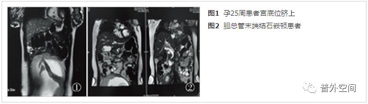 腹腔镜胆囊切除术加胆总管取石术,孕妇胆囊总管结石手术