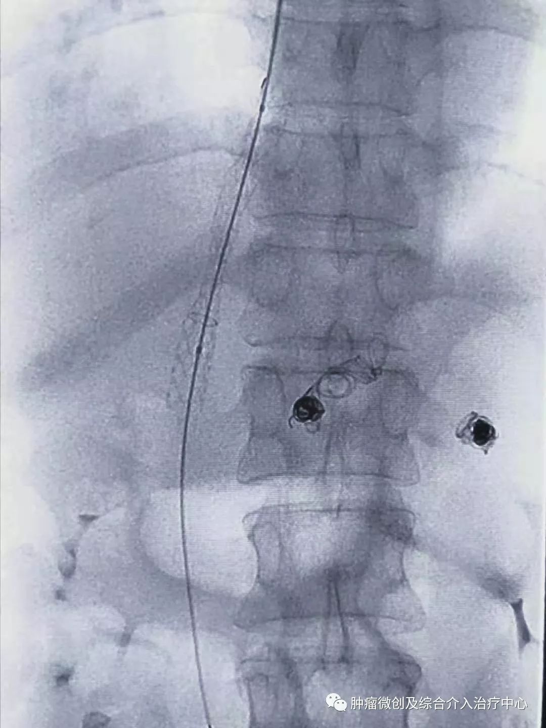 难治性消化道出血及难治性腹水的微创介入治疗-TIPS,运城市第一医院综合介入科