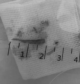 这画面太美！七旬阿婆脚拇趾疼痛流脓2年，原来竟是小东西惹的大祸