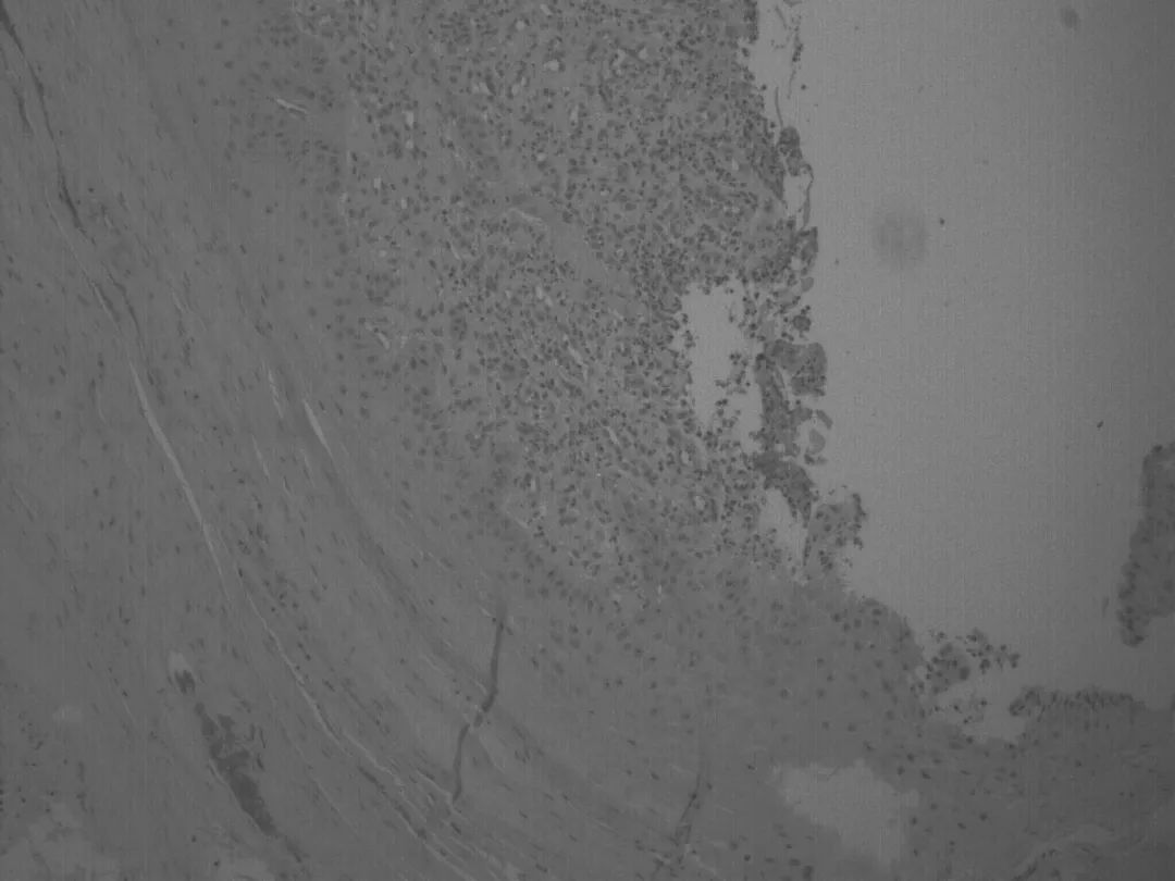 这画面太美！七旬阿婆脚拇趾疼痛流脓2年，原来竟是小东西惹的大祸