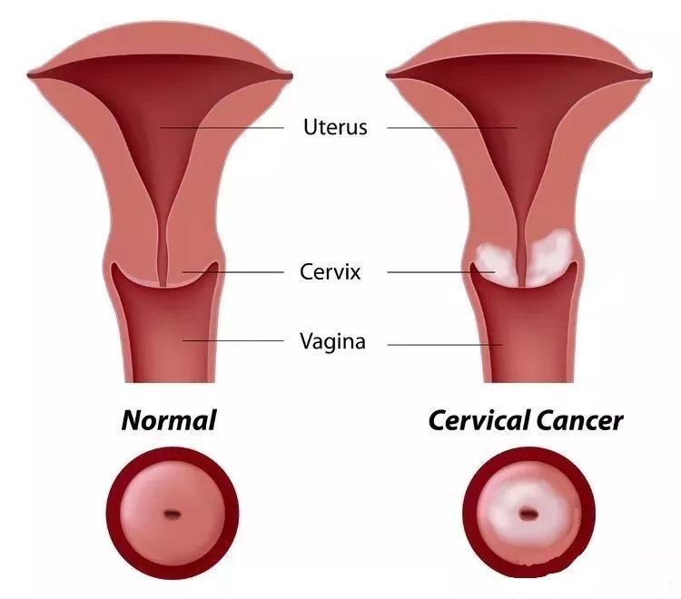 月经异常一年后检查宫颈癌晚期,55岁来月经是宫颈癌的前兆吗