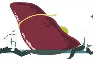 病毒性肝炎的历史,病毒性肝炎肝硬化肝癌的发展过程