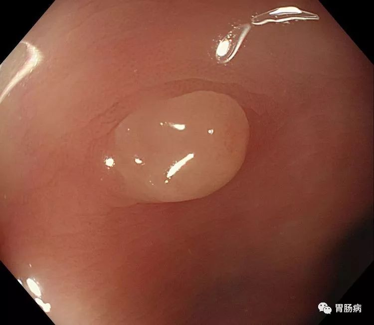 全面解读：结直肠息肉