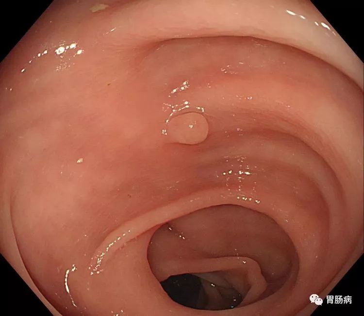 全面解读：结直肠息肉