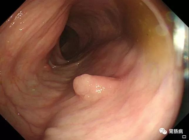 全面解读：结直肠息肉