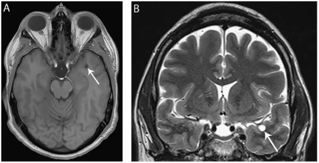 多图多表：带你识别颅内囊肿的影像学表现丨实战读片