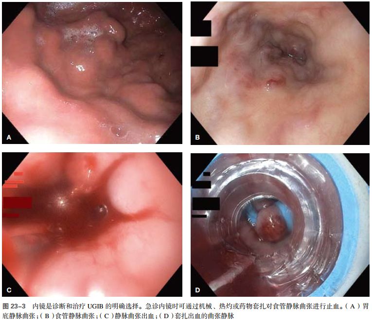 上消化道出血是什么病能治好吗,上消化道出血什么原因导致的