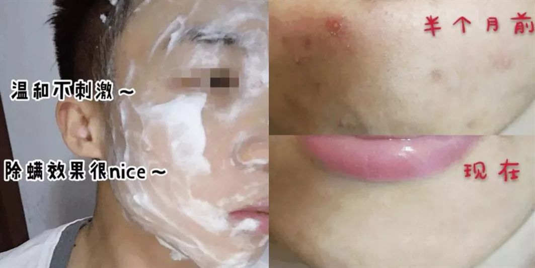 鼻头痘痘爆浆,鼻头痘痘挤出来的白色物质是什么