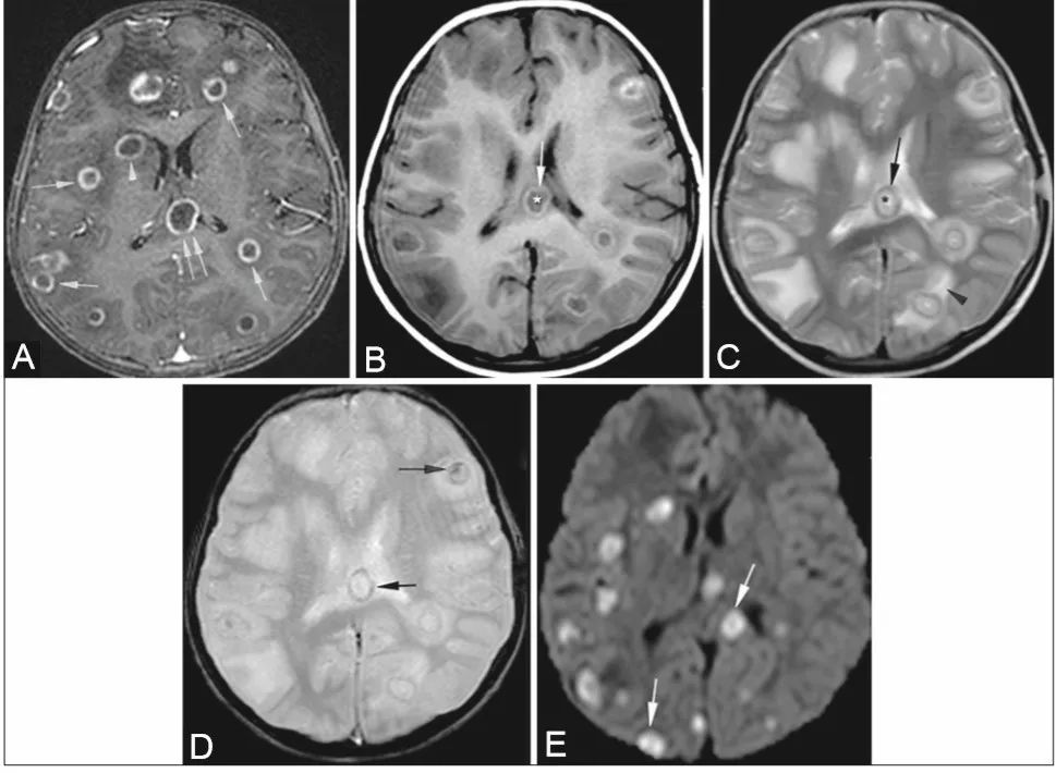 MMA伴cblC型并发ICH、巨细胞病毒脑室脑炎、霉曲菌感染丨3分钟读片·第6期