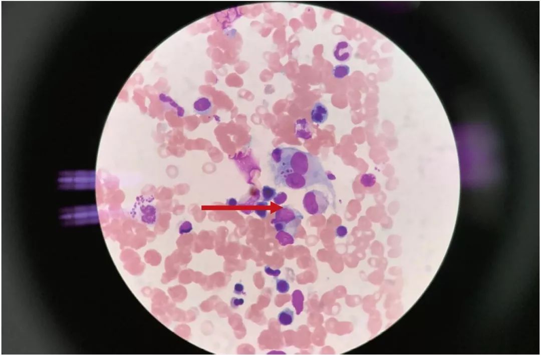 肝病核心力量锻炼,肝病引起脾肿大怎么治