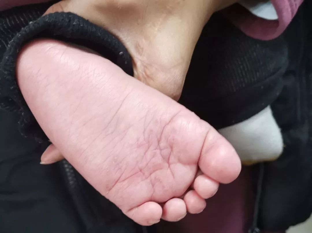 8个月的宝宝竟然得了“香港脚”！医生：梅雨季尤其要多关注