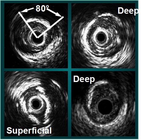 主动脉及冠状动脉钙化是什么病变,冠状动脉钙化影像学表现