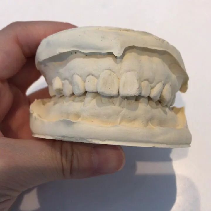 大龄整牙,错过生长发育期怎么办