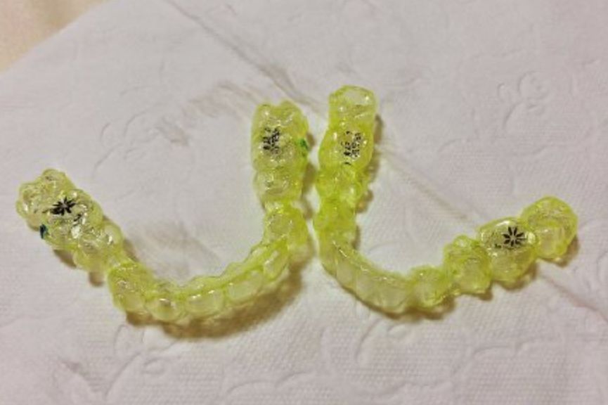 大龄整牙,错过生长发育期怎么办