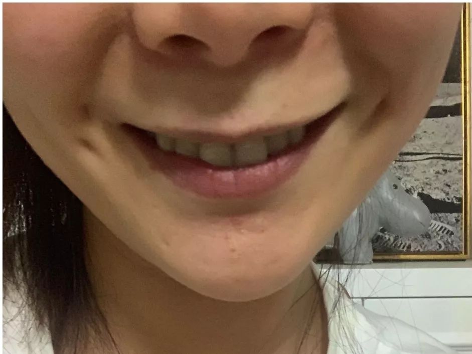 大龄整牙,错过生长发育期怎么办