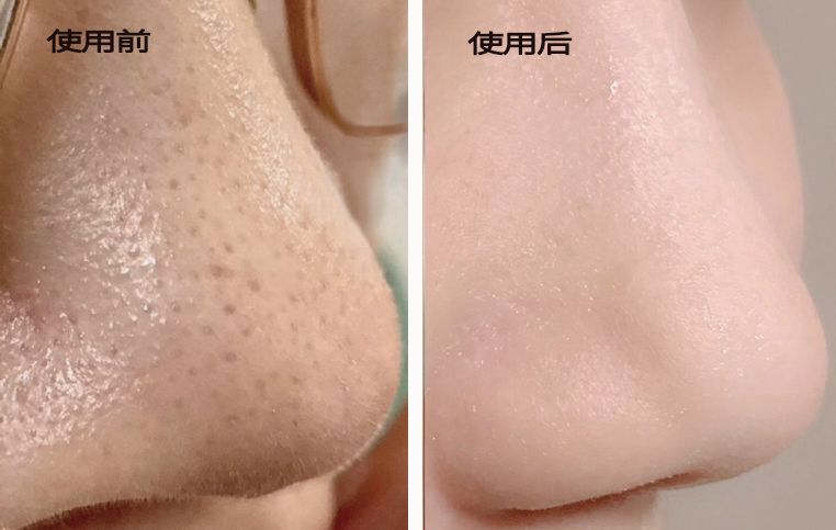 脸上搓下来很多泥,脸上搓出黑头